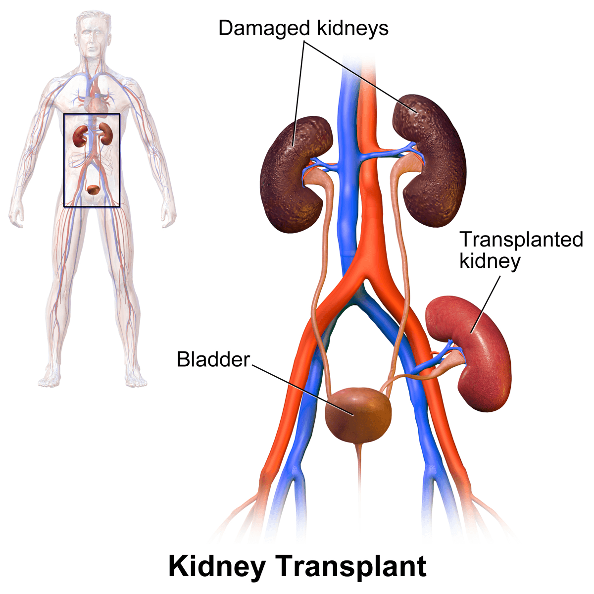 A medical illustration diagram showing a kidney transplant procedure